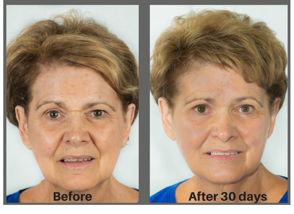 This is Nancy who used the best anti-aging skin care for 30 days.